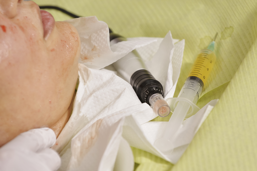 Microneedling in face