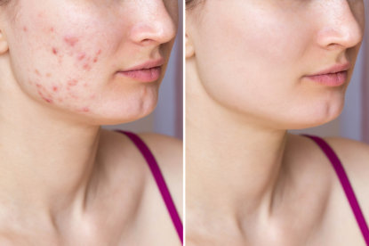 woman's face before and after using product